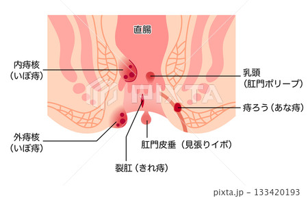痔の種類 肛門断面図 痔の種類 肛門断面図 133420193