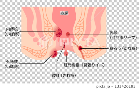 痔の種類 肛門断面図 痔の種類 肛門断面図 133420193