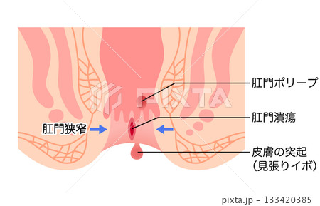 切れ痔　痔の種類　肛門ポリープ　肛門断面図 133420385