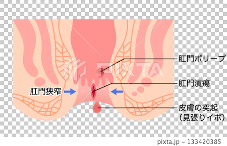 切れ痔　痔の種類　肛門ポリープ　肛門断面図 133420385