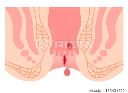 切れ痔　痔の種類　肛門ポリープ　肛門断面図 133431652
