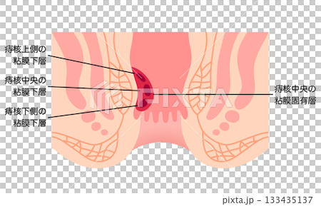 Hemorrhoids - Structure of hemorrhoids - Cross section of the anus 133435137