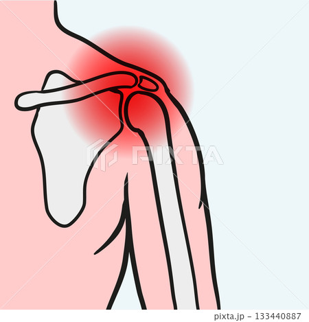 Shoulder pain showing injury or arthritis 133440887