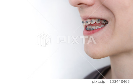 Close-up of a smiling young person with metal dental braces on their teeth. Orthodontic treatment, dental care 133448465