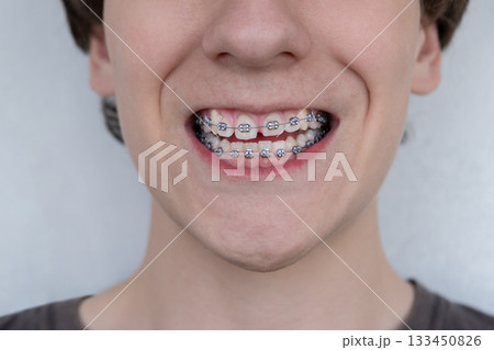 Close-up of a smiling young person with metal dental braces on their teeth. Orthodontic treatment, dental care 133450826