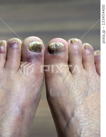 足　指　爪　爪水虫 133454400