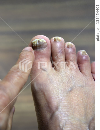 足　指　爪　爪水虫 133454401