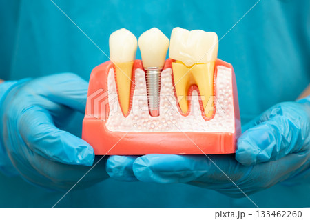 Asian dentist holding dental implant, artificial tooth roots into jaw, root canal of dental treatment, gum disease, teeth model for dentist. Asian dentist holding dental implant, artificial tooth roots into jaw, root canal of dental treatment, gum disease, teeth model for dentist. 133462260