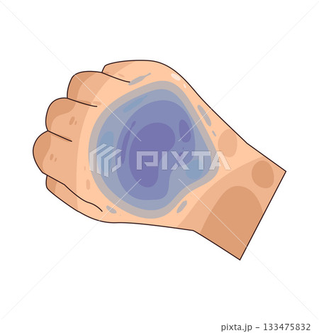 illustration of Bruise 133475832