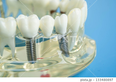 Dental implant, artificial tooth roots into jaw, root canal of dental treatment, gum disease, teeth model for dentist studying about dentistry. 133480897