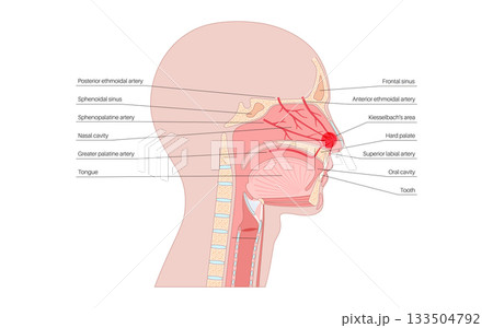 Nosebleed medical poster Nosebleed medical poster 133504792
