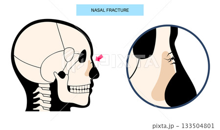Nasal fracture poster 133504801