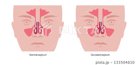 Deviated septum poster Deviated septum poster 133504810