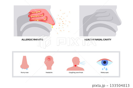 Allergic rhinitis poster 133504813