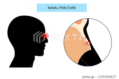 Nasal fracture poster 133504817