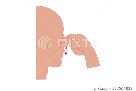 Stop nosebleed instruction Stop nosebleed instruction 133504822