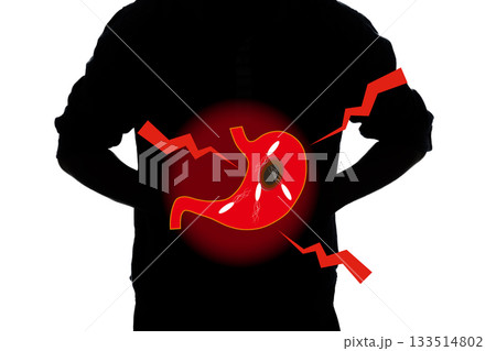 胃の病気 ピロリ菌 胃潰瘍 胃の病気 ピロリ菌 胃潰瘍 133514802