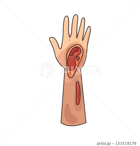 illustration of wound illustration of wound 133518176