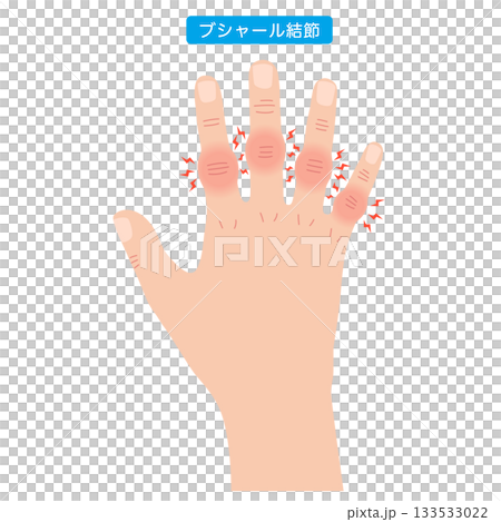 Bouchard's nodes: a disease of the finger joints 133533022