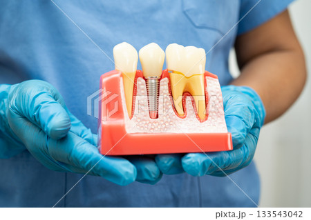 Dentist holding dental implant, artificial tooth roots into jaw, root canal of dental treatment, gum disease, teeth model for dentist. Dentist holding dental implant, artificial tooth roots into jaw, root canal of dental treatment, gum disease, teeth model for dentist. 133543042