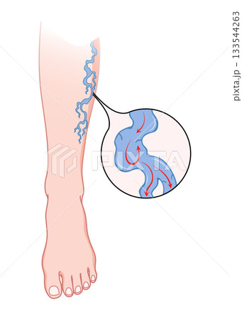Varicose veins. Blue blood vessel visible through the skin, abnormally swollen leg. Vascular disease diagnostic and treatment. Venous insufficiency medical disease Varicose veins. Blue blood vessel visible through the skin, abnormally swollen leg. Vascular disease diagnostic and treatment. Venous insufficiency medical disease 133544263