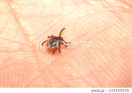 手のひらの上のフタトゲチマダニ 133545579