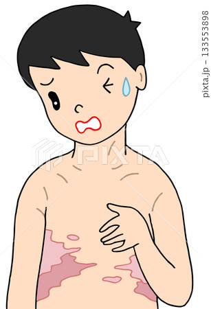 病気・疾患・疾病  - 帯状疱疹・帯状ヘルペス・赤班 133553898