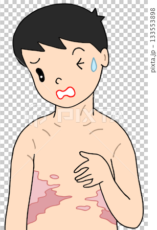 病気・疾患・疾病  - 帯状疱疹・帯状ヘルペス・赤班 133553898