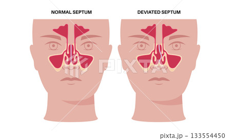 Deviated septum poster 133554450