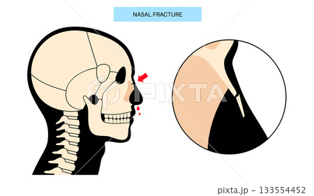Nasal fracture poster 133554452