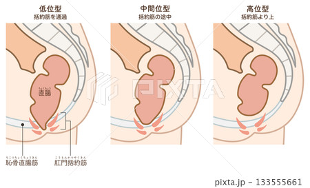 鎖肛のイラスト、imperforate anus(ARM) illustration 133555661