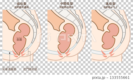 鎖肛のイラスト、imperforate anus(ARM) illustration 133555661