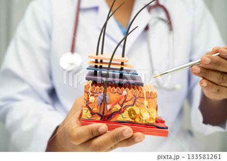 Hair transplant, Asian dermatologist doctor holding skin structure anatomy model for treatment in hospital. Hair transplant, Asian dermatologist doctor holding skin structure anatomy model for treatment in hospital. 133581261