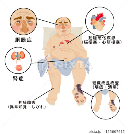 糖尿病合併症　網膜症・腎症・神経障害・足病変・動脈硬化　全身症状イラスト（医療・看護・患者説明） 133607615