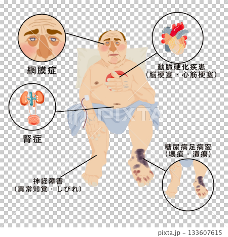 糖尿病合併症　網膜症・腎症・神経障害・足病変・動脈硬化　全身症状イラスト（医療・看護・患者説明） 133607615