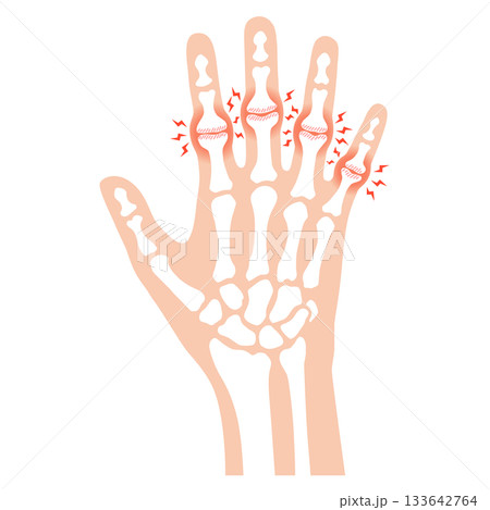 ブシャール結節　指の関節の病気 133642764