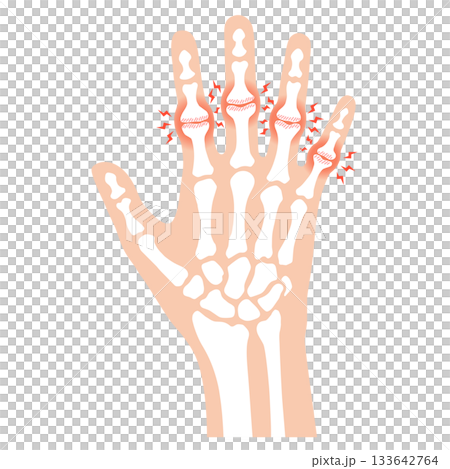 ブシャール結節　指の関節の病気 133642764