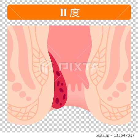 Progression of internal hemorrhoids Stage II Anal disease Progression of internal hemorrhoids Stage II Anal disease 133647017
