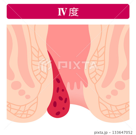 内痔核の進行度 ステージⅣ度 肛門の病気 内痔核の進行度 ステージⅣ度 肛門の病気 133647052