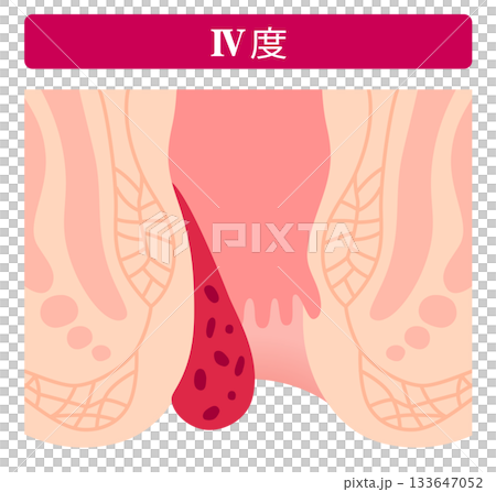 内痔核の進行度 ステージⅣ度 肛門の病気 内痔核の進行度 ステージⅣ度 肛門の病気 133647052