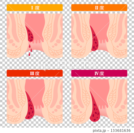 Progression of internal hemorrhoids, internal hemorrhoids grade I to IV, anal diseases Progression of internal hemorrhoids, internal hemorrhoids grade I to IV, anal diseases 133681636