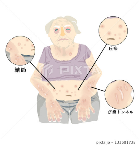 疥癬の皮膚症状イラスト　丘疹・結節・疥癬トンネルの図解　医療・看護教材向け 133681738