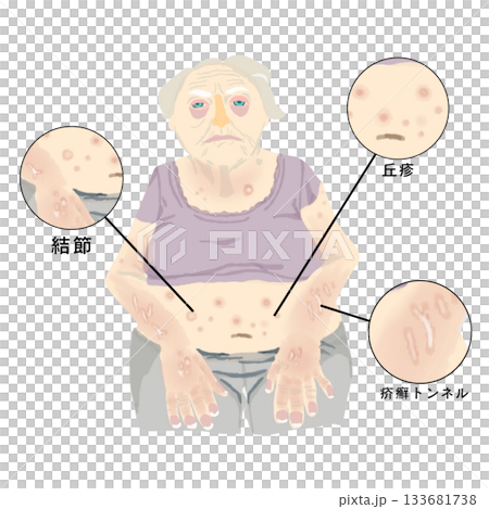 Illustrations of scabies skin symptoms: papules, nodules, and scabies burrows. For medical and nursing education. 133681738