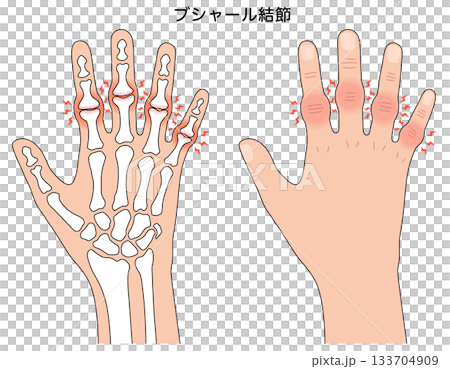 Bouchard's nodes: a disease of the finger joints 133704909