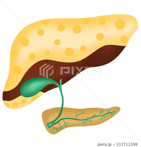 Fatty Liver Disease or Steatosis, Accumulation of Fat in the Human Liver Organ, hand drawn watercolor illustration 133711399