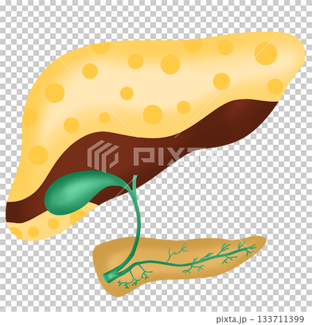 Fatty Liver Disease or Steatosis, Accumulation of Fat in the Human Liver Organ, hand drawn watercolor illustration 133711399