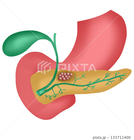 Pancreatic Cancer, Malignant Tumor in Pancreas, hand drawn watercolor illustration 133711400