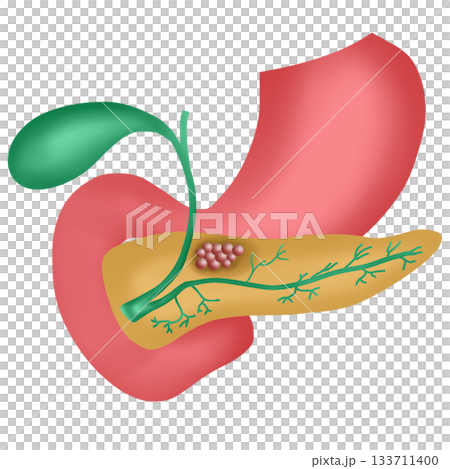 Pancreatic Cancer, Malignant Tumor in Pancreas, hand drawn watercolor illustration 133711400