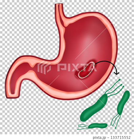 Helicobacter Pylori Bacteria Causing Peptic Ulcer Disease in Human Stomach Helicobacter Pylori Bacteria Causing Peptic Ulcer Disease in Human Stomach 133715552
