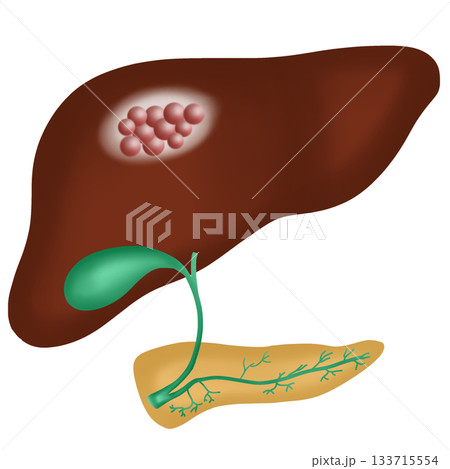Liver Cancer or Hepatocellular Carcinoma, Malignant Tumor in Human Liver Diagram, hand drawn watercolor illustration 133715554